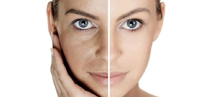 yüz cildi gençleştirmeden önce ve sonra